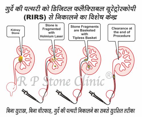 bilateral-kidney-stone-removal-in-dehradun