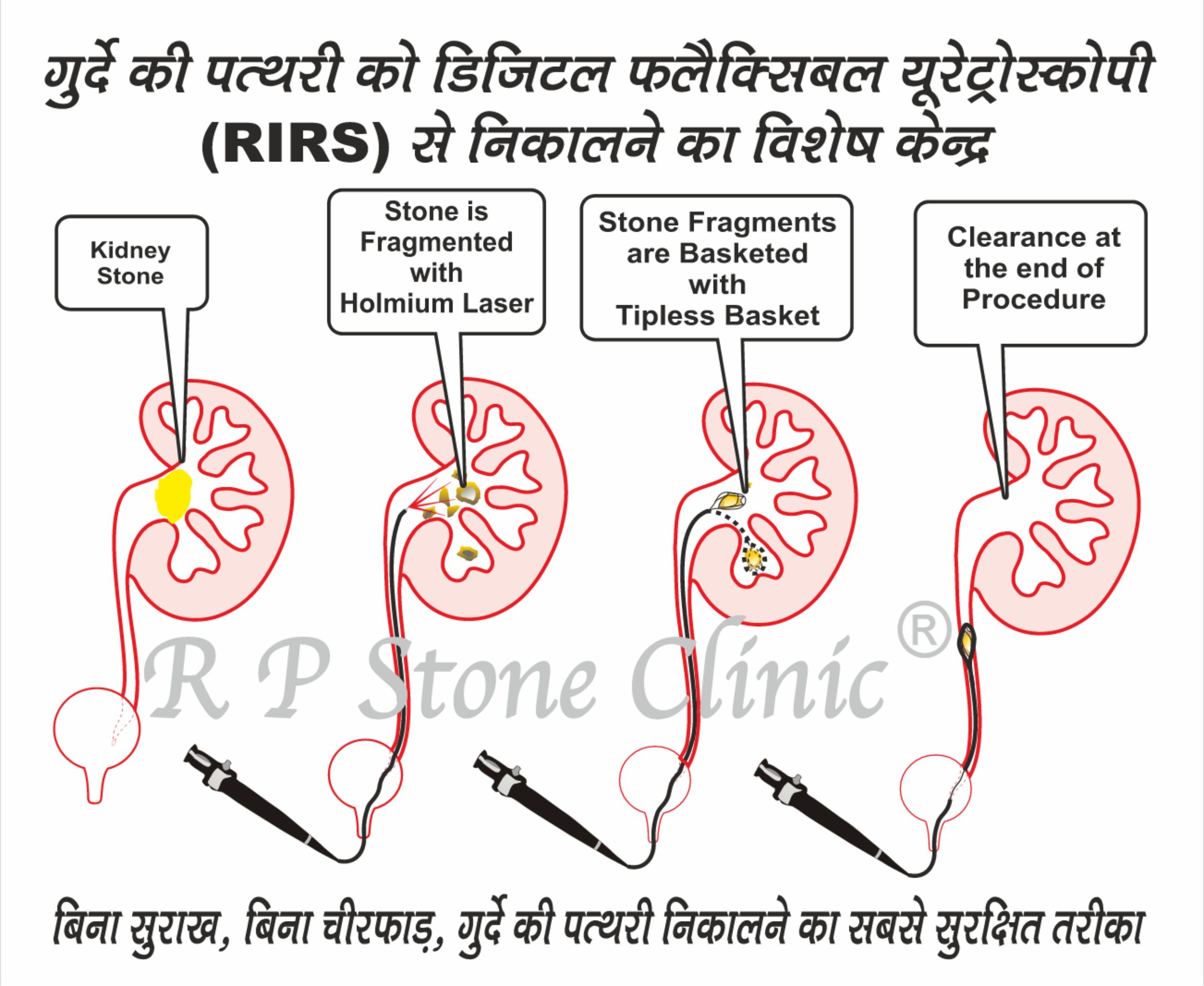 RIRS-safe-with-Chronic-Renal-Failure